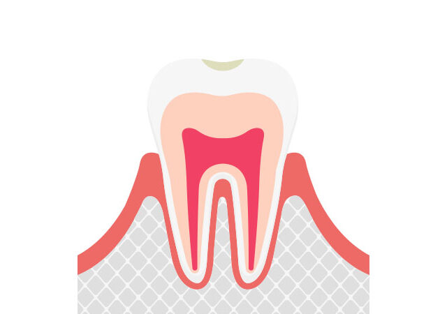 ごく初期のむし歯