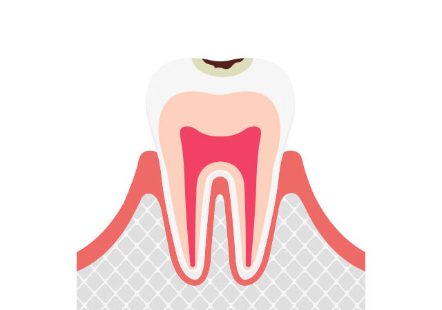 小さな穴が開いたむし歯