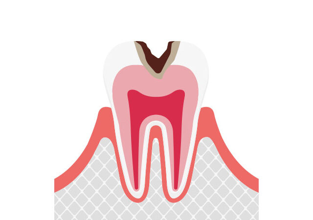 歯の内部まで進行したむし歯