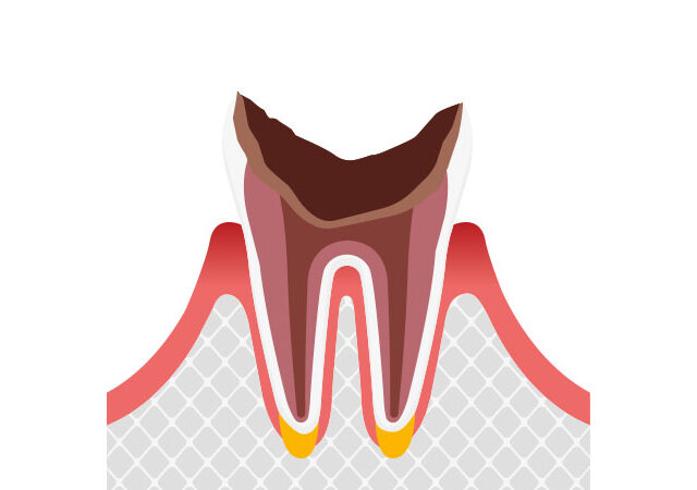歯根まで進行したむし歯